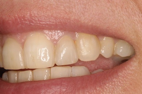 D6DentalVeneersA2
