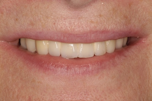 D6DentalVeneersA3