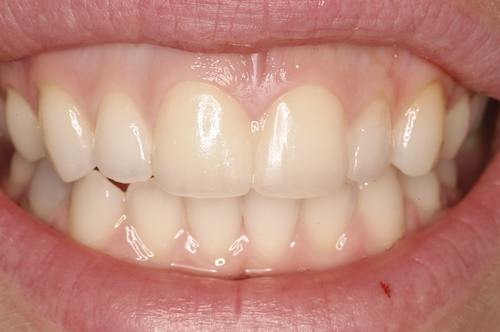 D6DentalVeneersA1