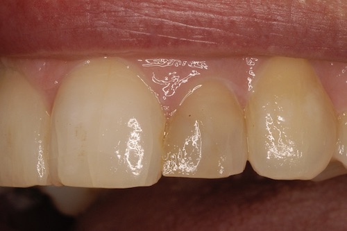D6DentalVeneersB2