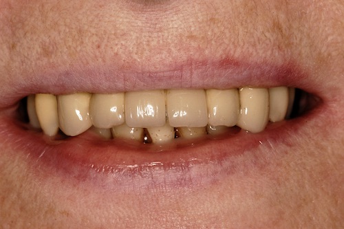 D6DentalVeneersB3
