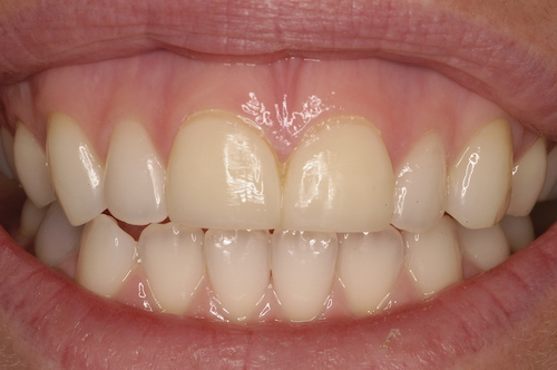 D6DentalVeneersB1